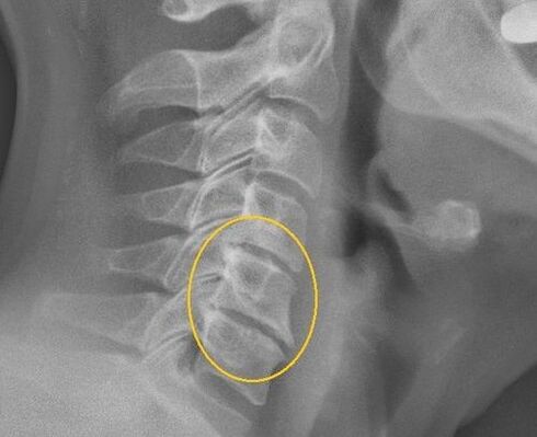 A méhnyak gerincének osteochondrosis egy x -seriségen