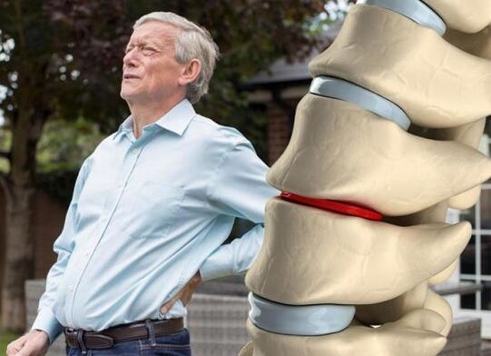 Az osteochondrosis az intervertebralis lemezeket érinti, és hátfájást okoz
